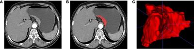 Evaluation of Epidermal Growth Factor Receptor 2 Status in Gastric Cancer by CT-Based Deep Learning Radiomics Nomogram